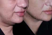 Facelift in Dubai