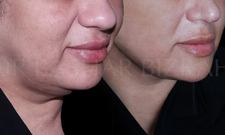 Facelift in Dubai